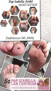Diabéteszes lábápolás - Pap Izabella Lábcentrum