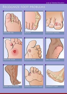 Bőrkeményedés, lábgomba - A 6 leggyakoribb lábgond - Egészségtüködorix.hu