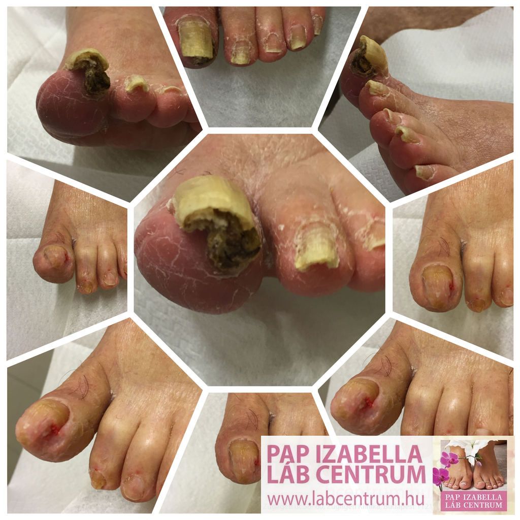 fekélyek a cukorbetegségben lábápolás cukorbetegség az ujját a fekélyek kezelésére