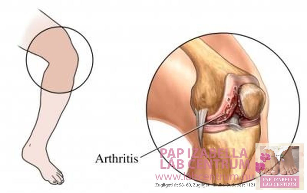 A lábak és a lábak ízületeinek kezelése. Reumatoid Artritis - Fájdalomközpont