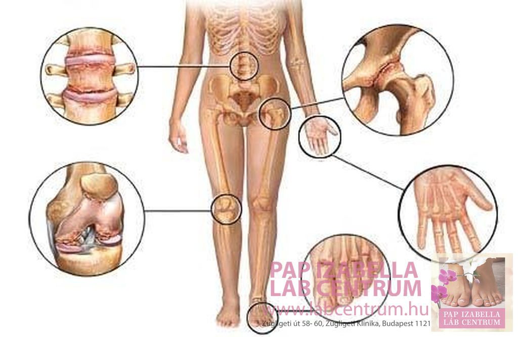 hogyan kell kezelni a láb arthrosisát