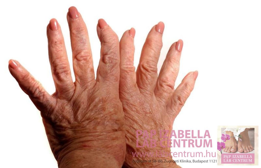 eos közös kezelésre ár térd szenilis artrózisa