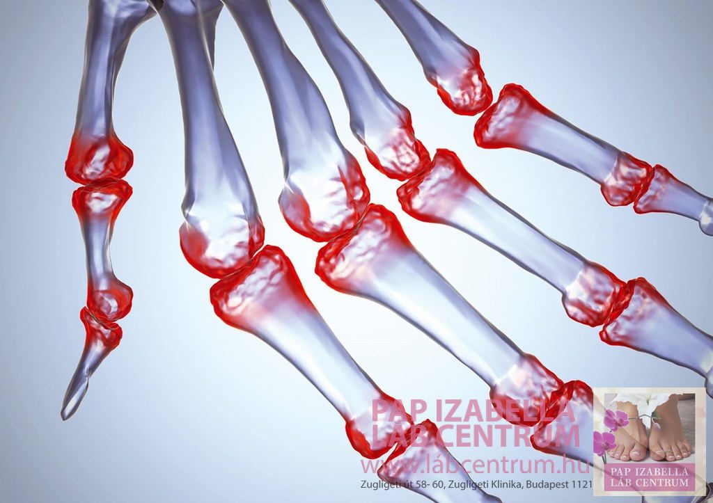 artróziskezelés jordániaban váll fájdalom kéz zsibbadás kezelése