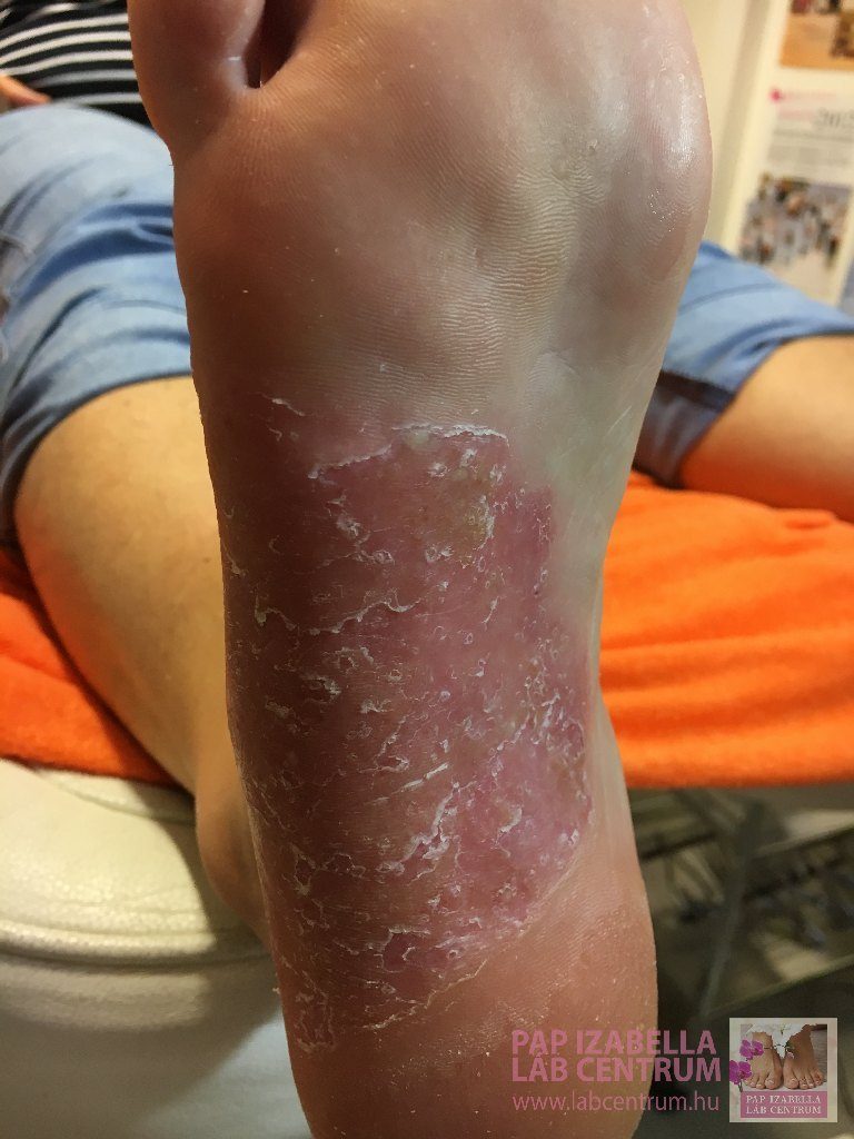 láb és kezek pikkelysömörének kezelése pikkelysömör kezelése a hagyományos gyógyítók által